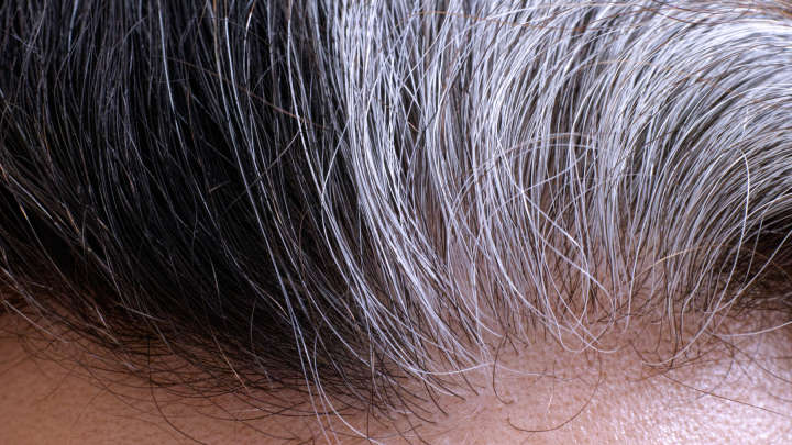 Immunotherapy Drugs Also Appear To Restore Hair Color In Patients