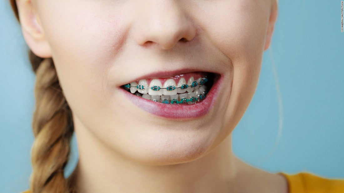Piece of dental braces removed from woman's intestine after 10 years