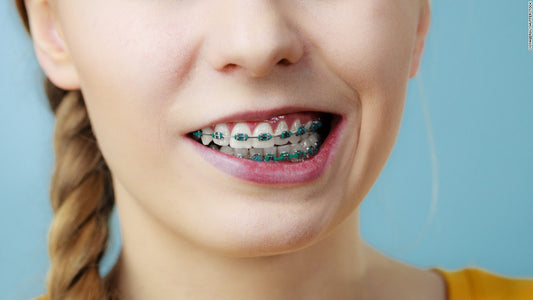 Piece of dental braces removed from woman's intestine after 10 years