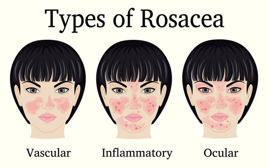 Causes of Rosacea