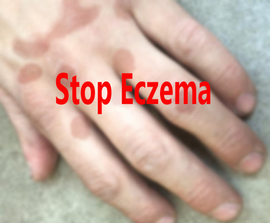 causes of eczema