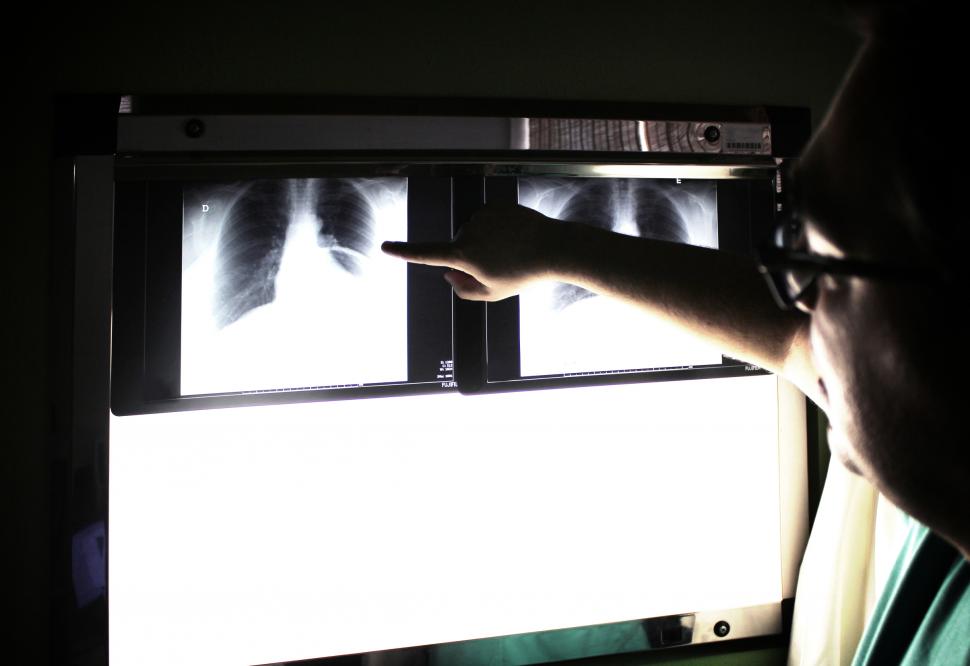 Causes of Pneumonia